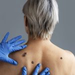 Skin Tag & Mole Removal