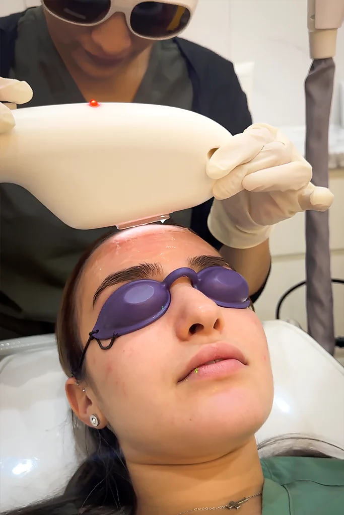 IPL Treatments