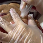 Microneedling Treatment