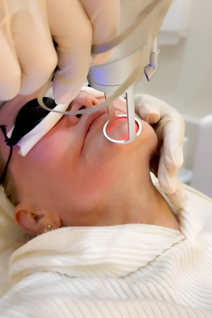 co2 laser treatment