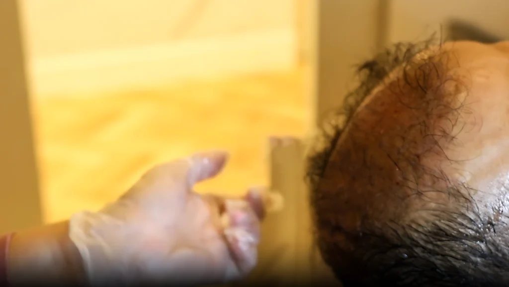 Hair Restoration