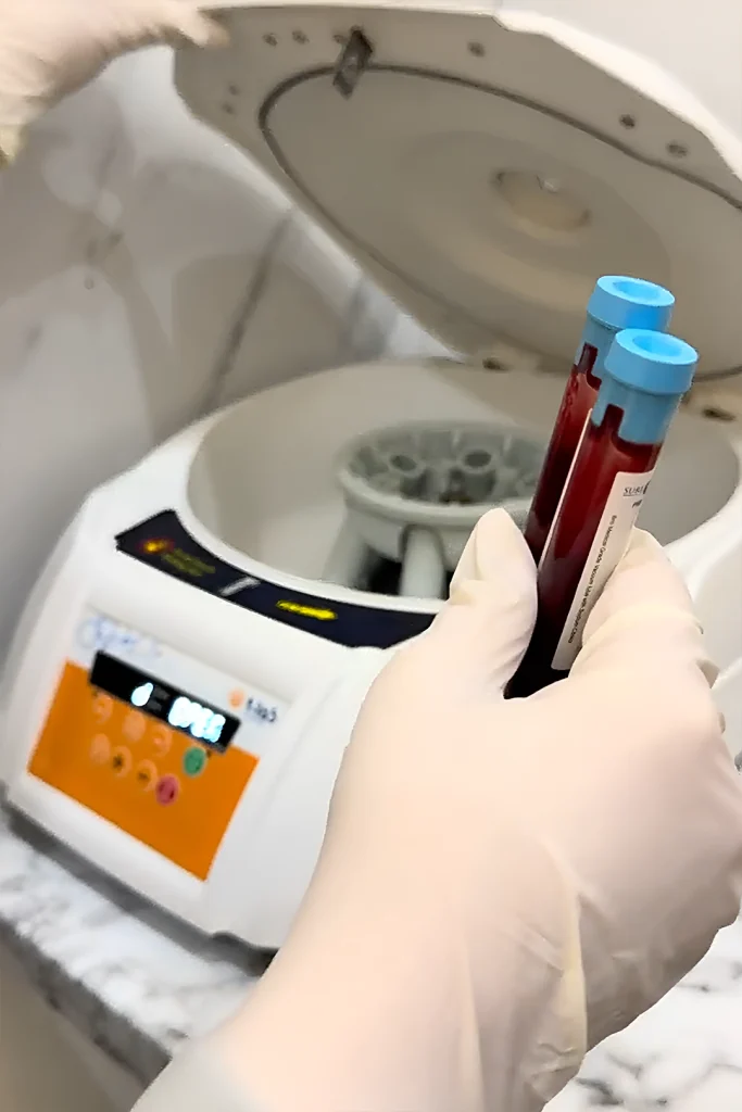 PRP Skin Treatment