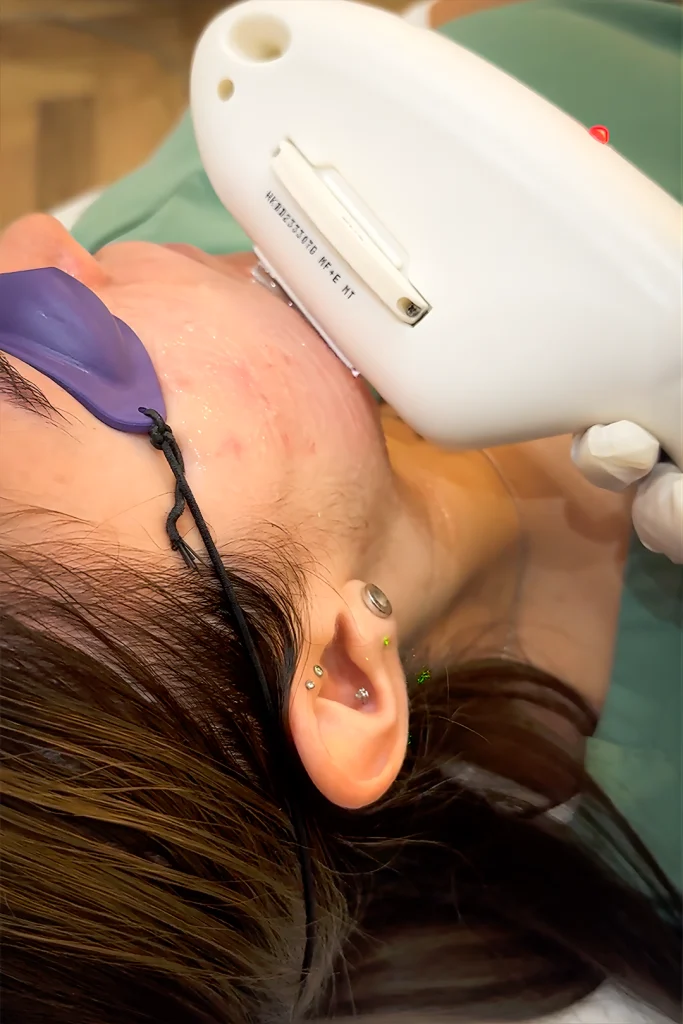 IPL Treatments