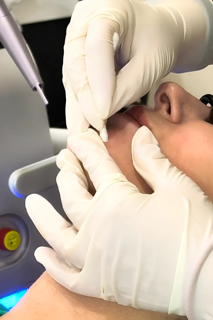 co2 laser treatment