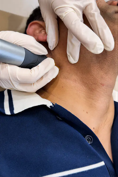 Hydraglow Treatment