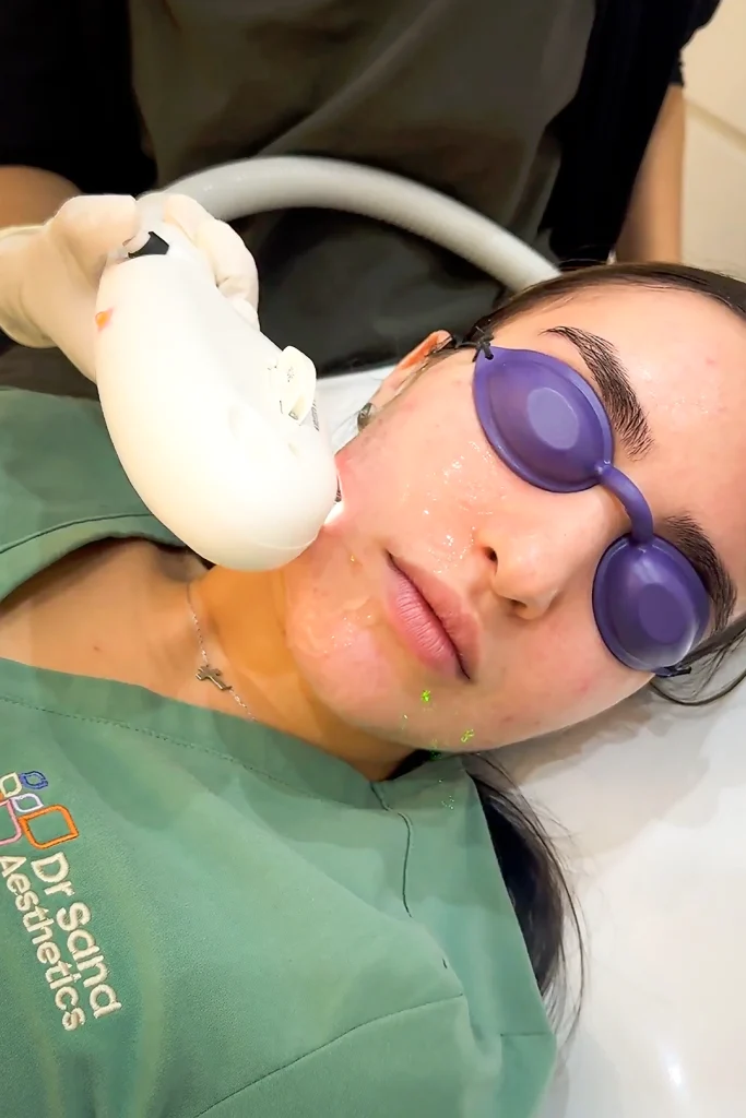 IPL Treatments