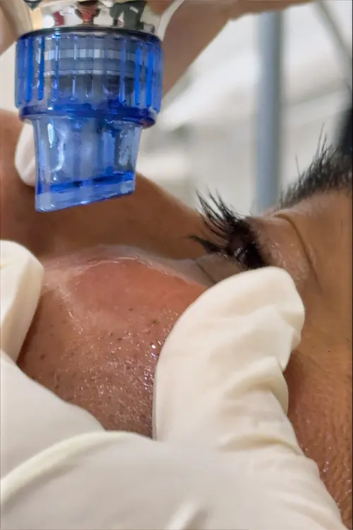 Hydraglow Treatment
