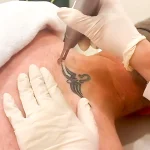 Tattoo Removal