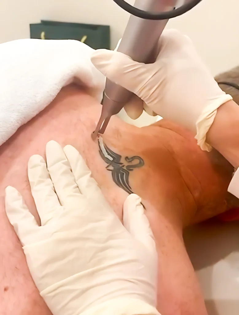 Tattoo Removal