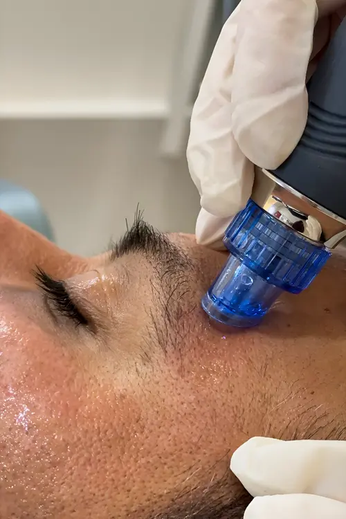 Hydraglow Treatment