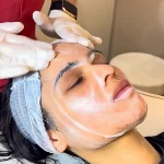 chemical peels