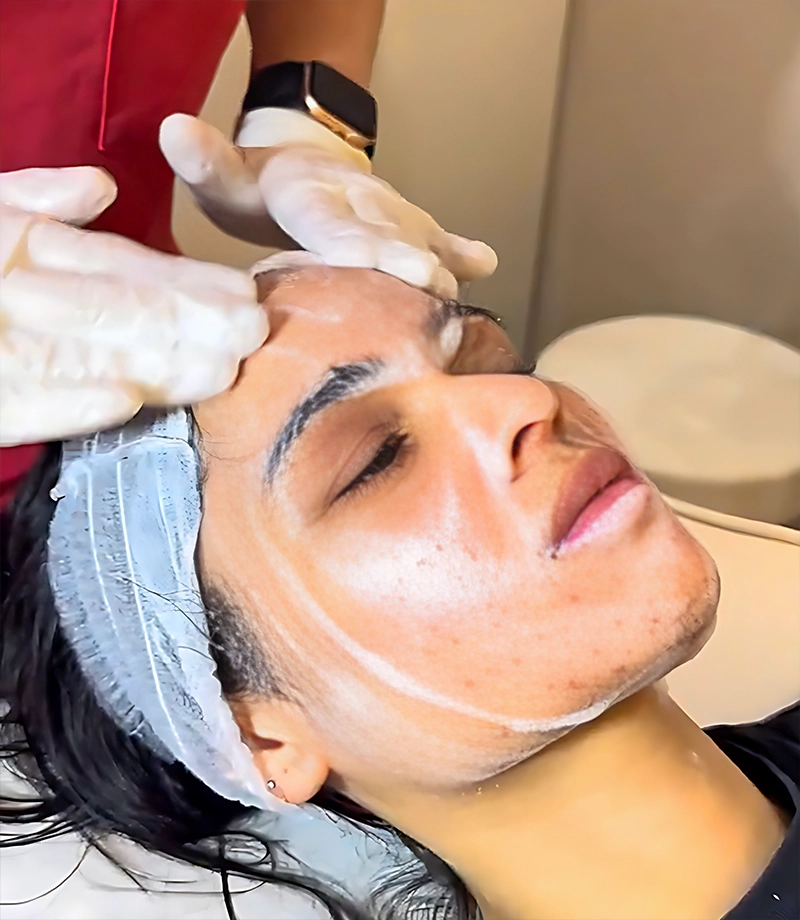 chemical peels