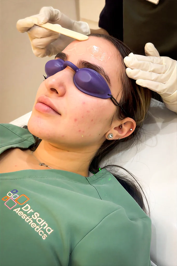 IPL Treatments