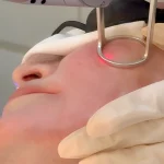 co2 laser treatment