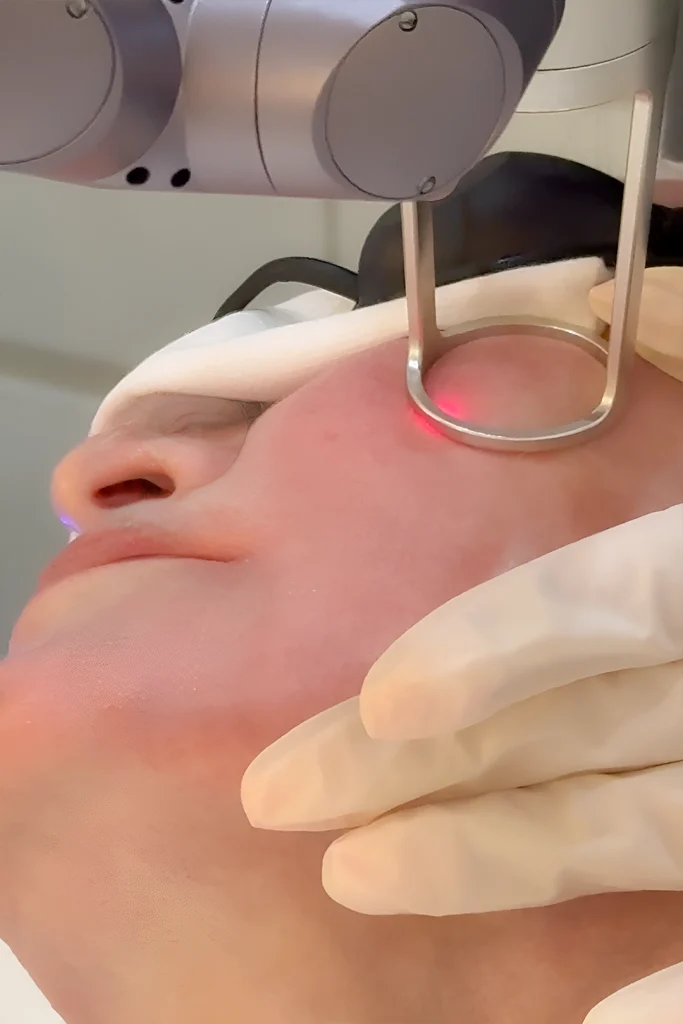 co2 laser treatment