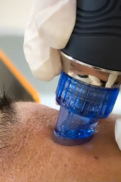 Hydraglow Treatment