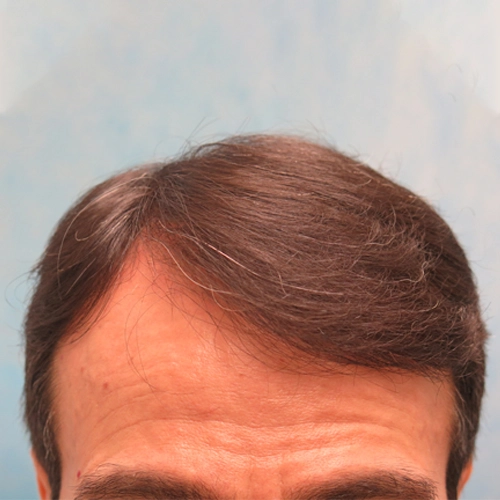 artas_hair_4_after.webp