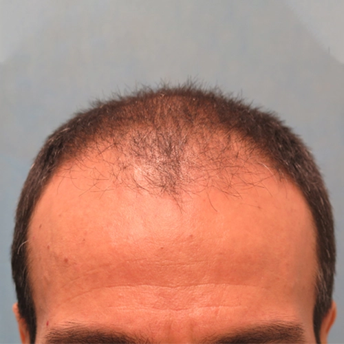 artas_hair_4_before.webp