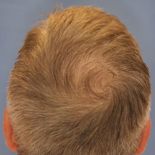 hair_restoration_a1.jpg