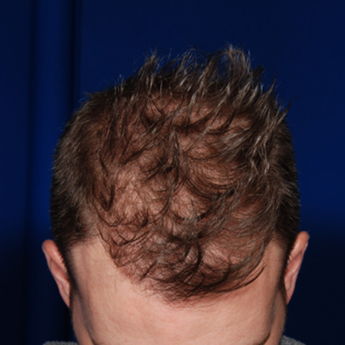neograft