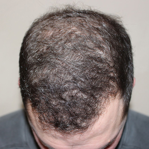 neograft