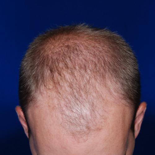 neograft