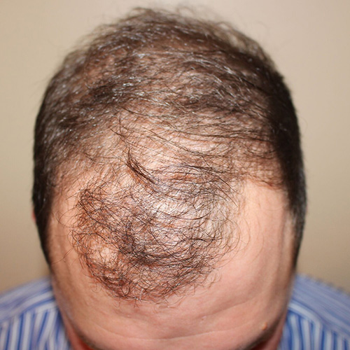 neograft